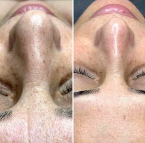 before and after the peel smooth skin