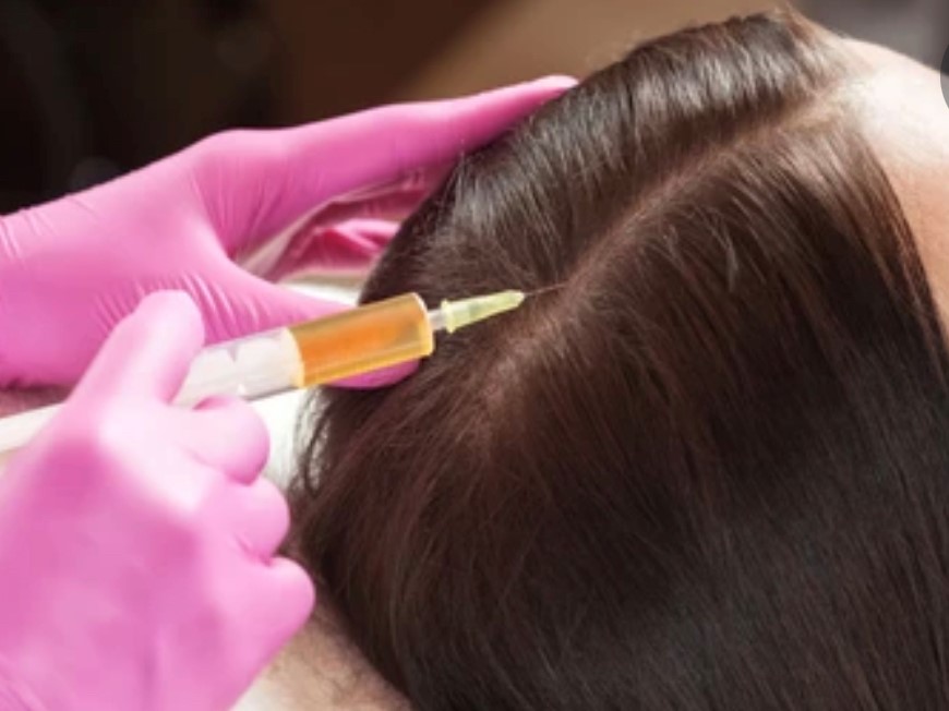 Scalp injection for hair loss 2